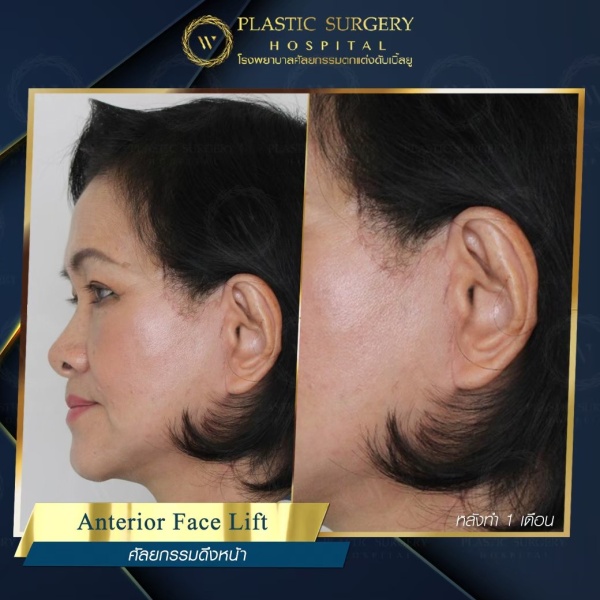 ดึงหน้า