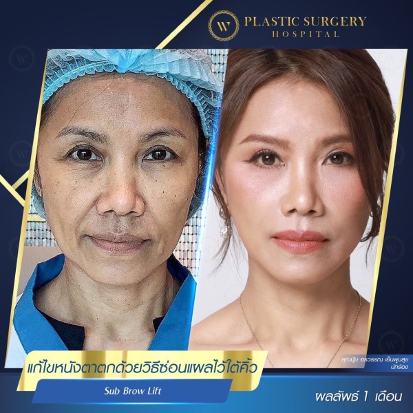 ศัลยกรรมแก้ไขปัญหาหนังตา