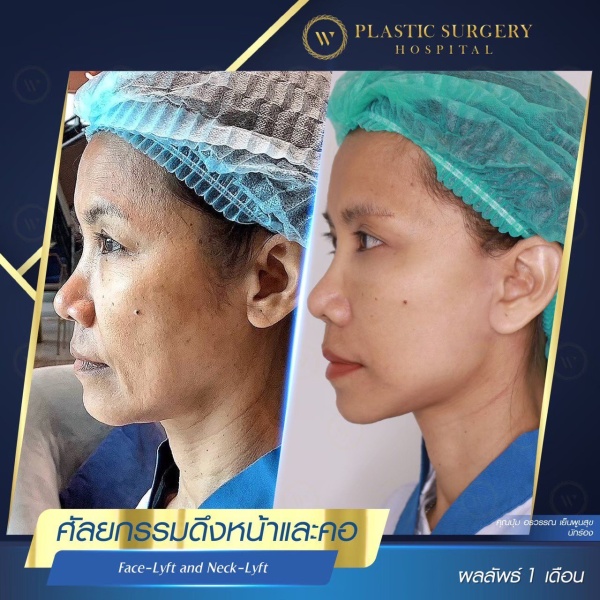 ดึงหน้า