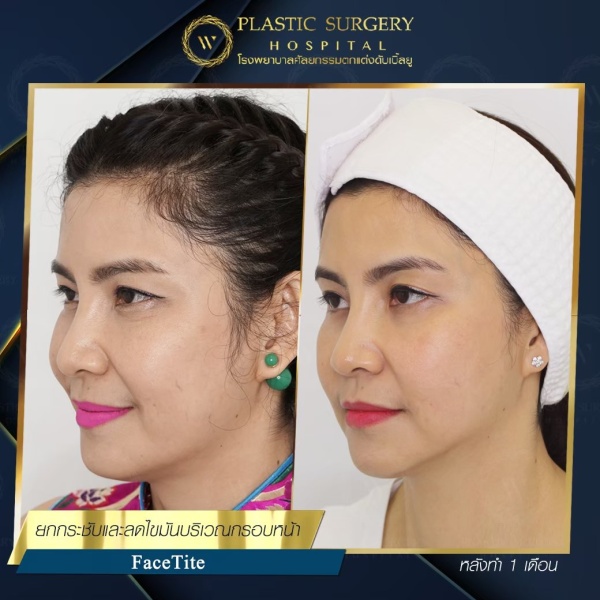 ดูดไขมันเหนียงใต้คาง (FaceTite)