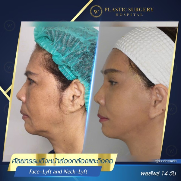 ดึงหน้า