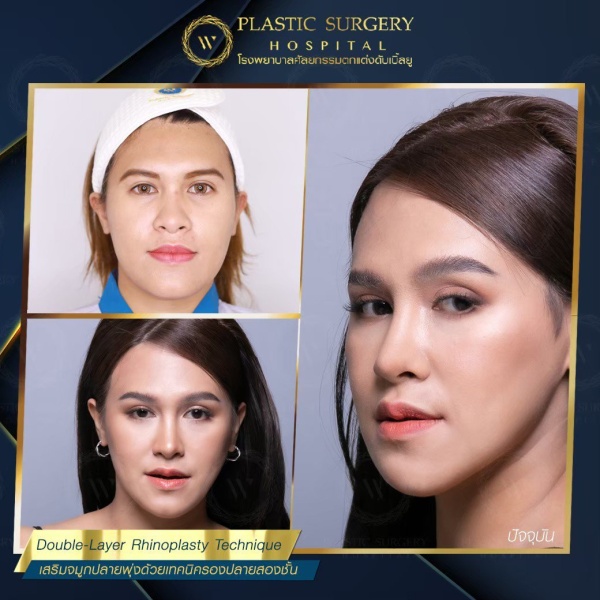 เสริมจมูก