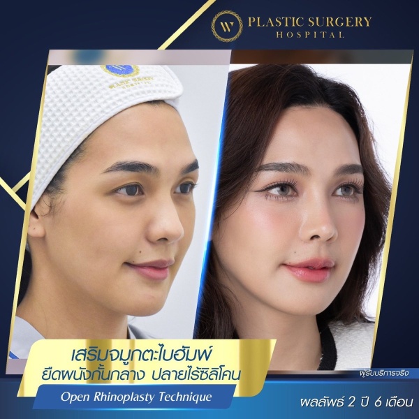 Nose Surgery