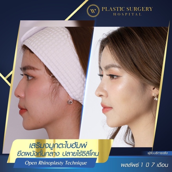 Nose Surgery