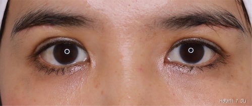 ศัลยกรรมแก้ไขปัญหาหนังตา