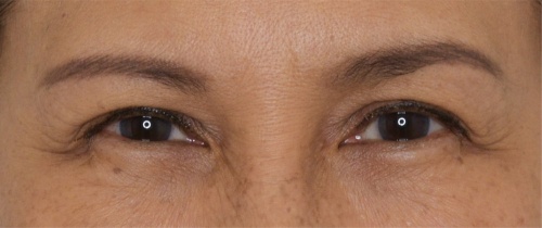 ศัลยกรรมแก้ไขปัญหาหนังตา