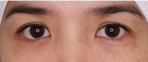 ศัลยกรรมแก้ไขปัญหาหนังตา