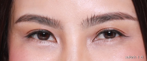 ศัลยกรรมแก้ไขปัญหาหนังตา