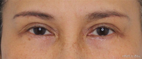 ศัลยกรรมแก้ไขปัญหาหนังตา