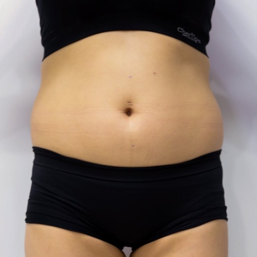 Liposuction