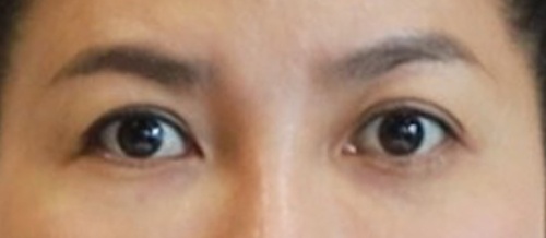 ศัลยกรรมแก้ไขปัญหาหนังตา