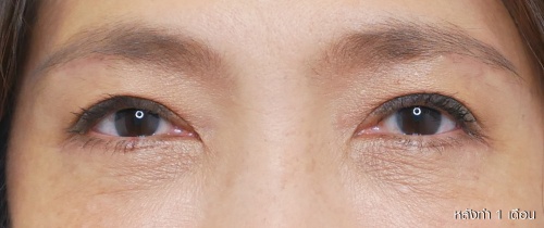 ศัลยกรรมแก้ไขปัญหาหนังตา