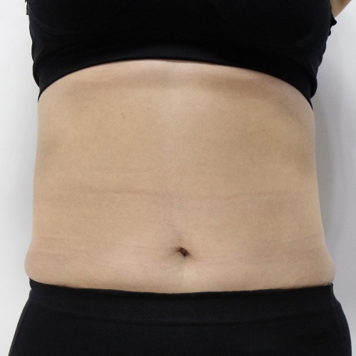 Liposuction