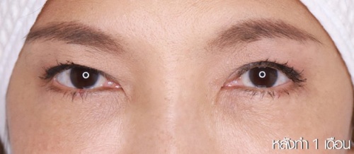 Lower Eyelid Surgery