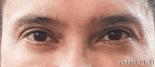 Lower Eyelid Surgery