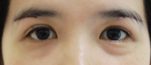 Lower Eyelid Surgery