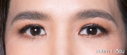 Lower Eyelid Surgery