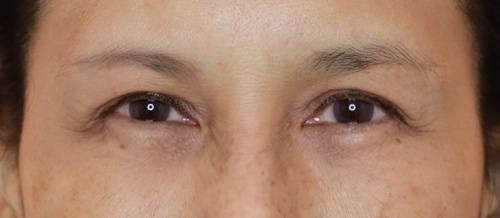 Lower Eyelid Surgery