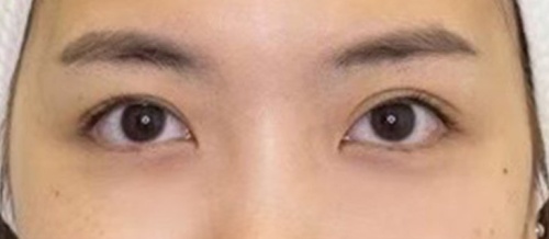 การทำศัลยกรรมตาสองชั้น