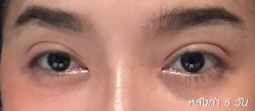 การทำศัลยกรรมตาสองชั้น