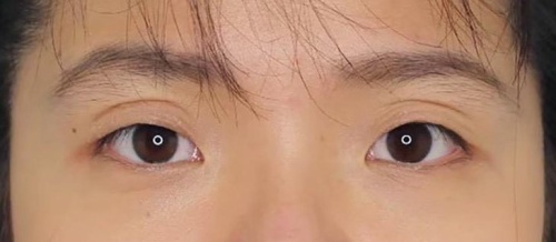 การทำศัลยกรรมตาสองชั้น