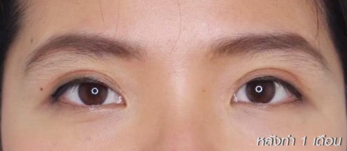 การทำศัลยกรรมตาสองชั้น