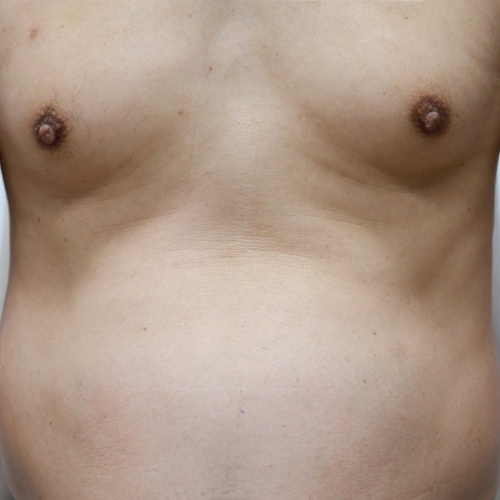 ลดขนาดหน้าอกผู้ชาย