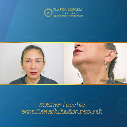 FaceTite ยกกระชับ และลดไขมันบริเวณกรอบหน้า