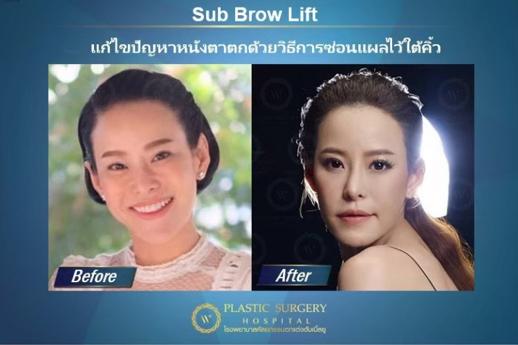 Sub Brow Lift การตัดยกชั้นตาให้ดูชัดเจนขึ้น โดยการซ่อนแผลไว้ที่ใต้คิ้ว