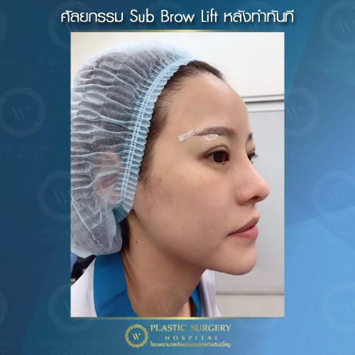 Sub Brow Lift การตัดยกชั้นตาให้ดูชัดเจนขึ้น โดยการซ่อนแผลไว้ที่ใต้คิ้ว