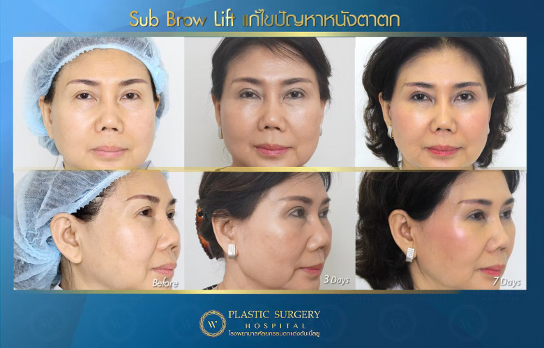 Sub Brow Lift การตัดยกชั้นตาให้ดูชัดเจนขึ้น โดยการซ่อนแผลไว้ที่ใต้คิ้ว