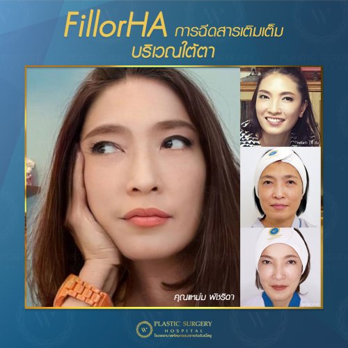 ฉีดสารเติมเต็ม ฉีดฟิลเลอร์ fillor HA