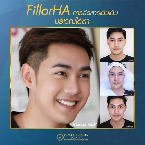 ฉีดสารเติมเต็ม ฉีดฟิลเลอร์ fillor HA