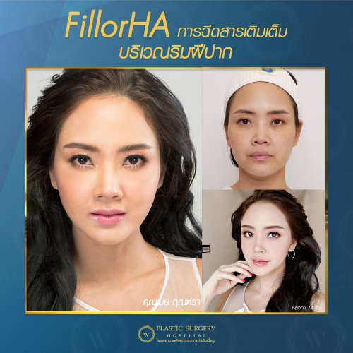 ฉีดสารเติมเต็ม ฉีดฟิลเลอร์ fillor HA