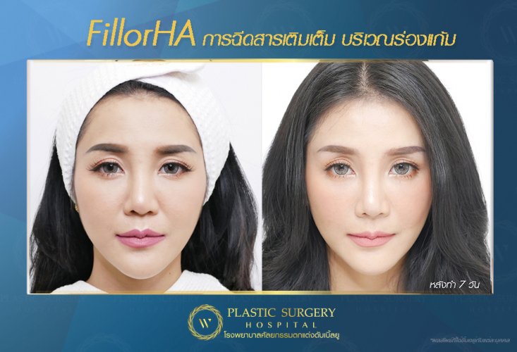 ฉีดสารเติมเต็ม ฉีดฟิลเลอร์ fillor HA