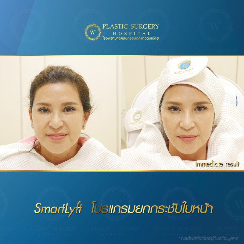 คุณบี โปรแกรมยกกระชับใบหน้า