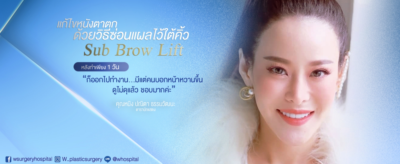 การศัลยกรรมแก้ไขปัญหาหนังตาหรือหางตาบนตก Sub Brow Lift.