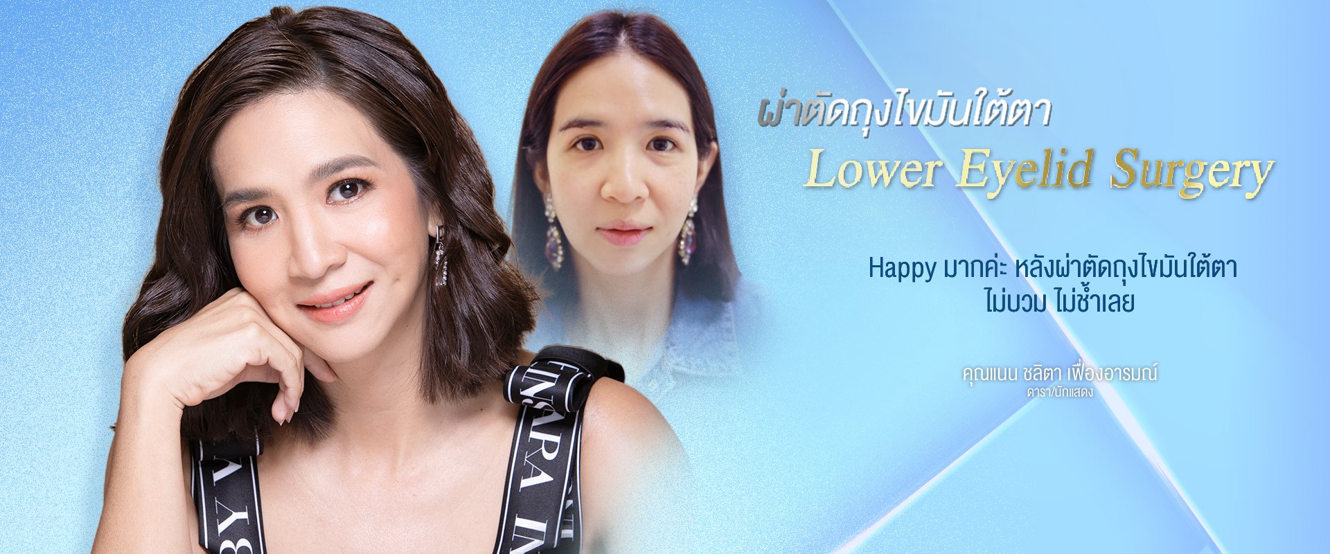 Lower Eyelid Surgery (Lower Blepharoplasty)